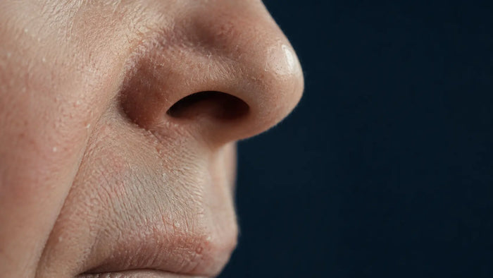 Dermatitis seborreica: qué es y por qué aparece