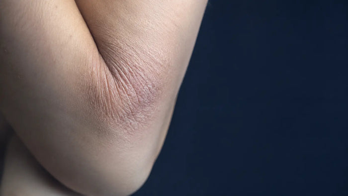 Dermatitis atópica en adultos: por qué aparece y cómo cuidar la piel