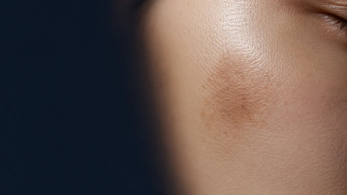 Manchas en la cara y melasma: ¿por qué vuelven?